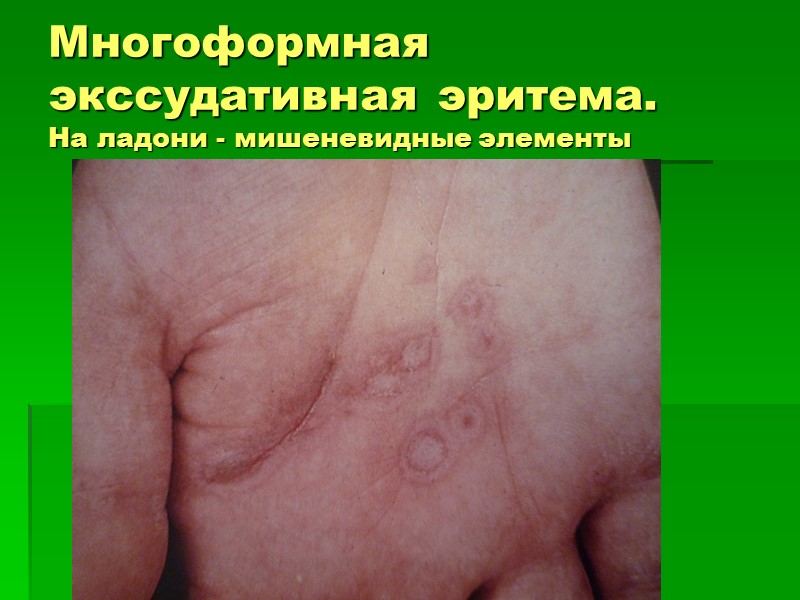 Многоформная экссудативная эритема.  На ладони - мишеневидные элементы